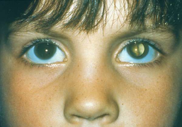 Наследственные заболевания глаз - коломба радужки